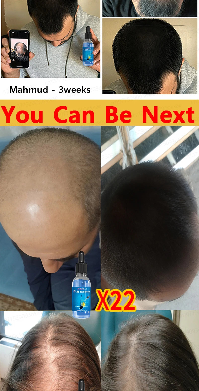 Natural Hair Growth & Hair Loss Control Essential Oil – Unisex Scalp Treatment, 30ml